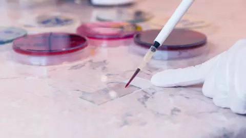 Anemia cu celule în seceră sau anemia falciformă. Iată tot ce trebuie să știi