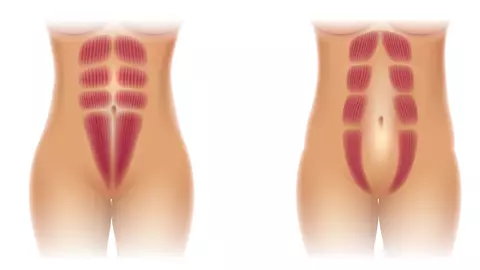 Ce este diastaza abdominală?