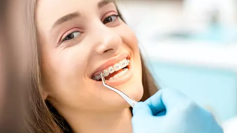 Aparat dentar la adulți. Soluția unui zâmbet perfect