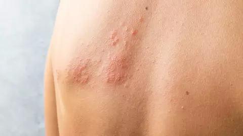 Zona Zoster afectează persoanele cu imunitate scăzută