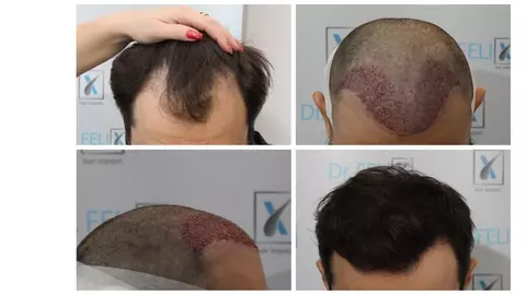 Implant de păr la Dr. Felix Hair Implant - schimbările de aspect care redau încrederea de sine