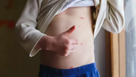 Atenție, părinți! Numărul cazurilor de varicelă este în creștere