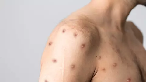 Simptomele și cauzele infecțiilor cu variola maimuțelor