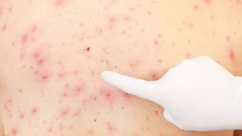 Diferența dintre variola maimuțelor și varicelă. Iată deosebirea dintre cele două boli