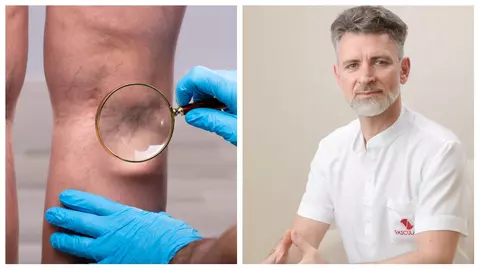 Dr. Toni Feodor: "Compresia reprezintă una dintre metodele eficiente de tratament pentru varice"