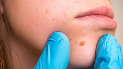 Semnele cancerului de piele pe care NU trebuie să le ignori