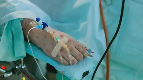 Variola maimuțelor depistată în România la un tânăr de 26 de ani. Cum se simte bărbatul?