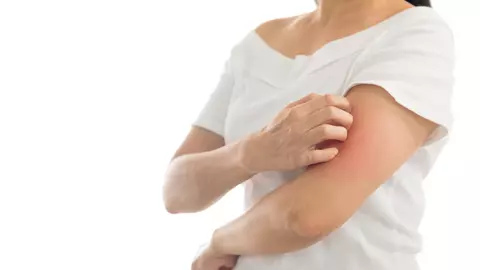 De ce mușcăturile de insecte provoacă mâncărime?