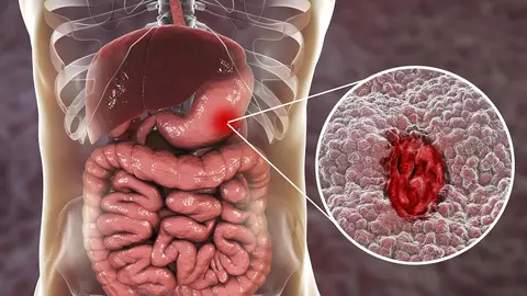 Cele 13 simptome ale cancerului pe care trebuie neapărat să le verificați