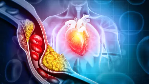 5 metode naturale de a scădea colesterolul fără medicație