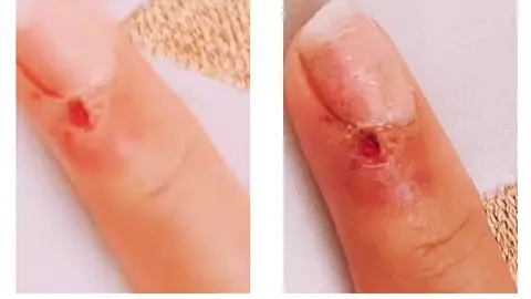 A mers la salon să-și facă manichiura și a plecat cu virusul HPV