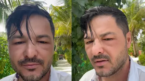 Liviu Vârciu, cu fața tumefiată în vacanță. Ce a pățit prezentatorul: „Am impresia că acum încep să mă umflu și mai tare”