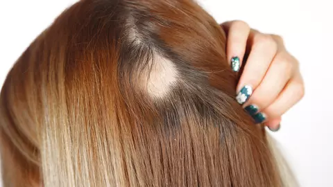 Alopecia sau căderea părului: care sunt primele semne ce apar?