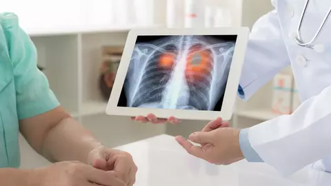Medicii români pot învăța o nouă tehnică chirurgicală minim invazivă pentru tratarea cancerelor pulmonare