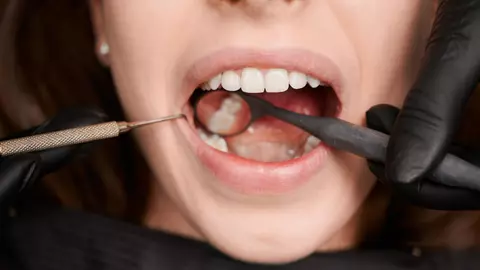 Care este diferența dintre coroană și implant dentar?