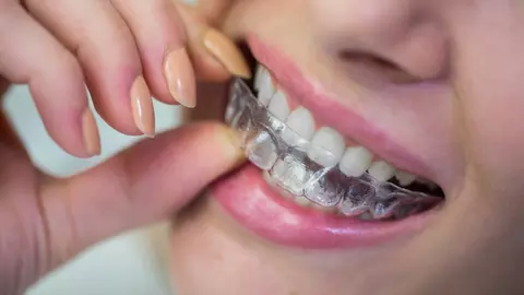 Bruxismul și cariile: cum să previi apariția acestor probleme dentare