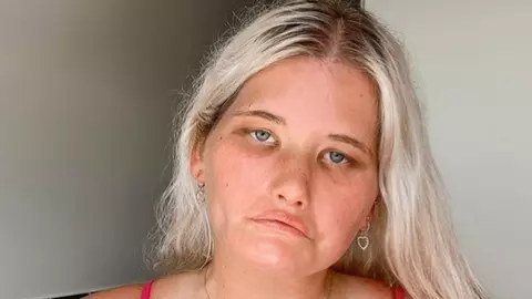 Ce este sindromul Moebius? O femeie a demonstrat că frumusețea poate căpăta sensuri diferite