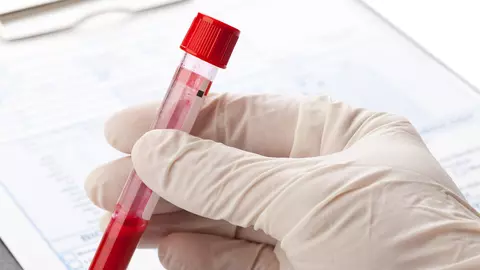 Românii beneficiază de analize gratuite pentru diagnosticarea Bolii Cronice de Rinichi, începând cu 1 iulie