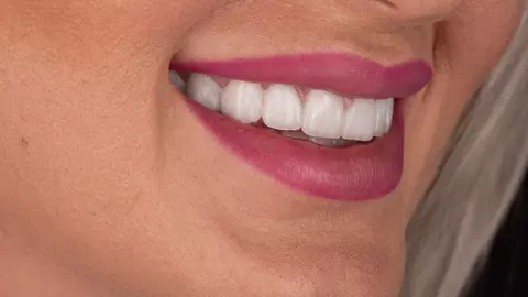 Top 5 Motive pentru care femeile doresc să-și pună Fațete Dentare
