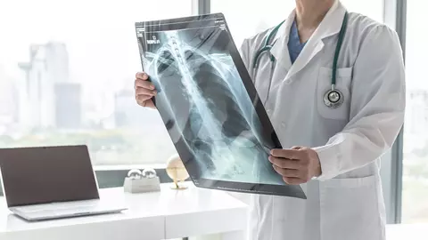 Mic ghid al pacientului în fața cancerului bronho-pulmonar - de la diagnostic la strategii de tratament