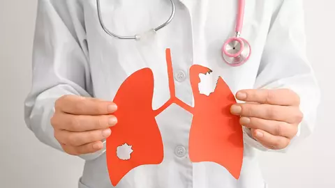 Influența diagnosticului precoce asupra evoluției cancerului bronho-pulmonar