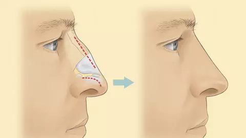 Te gândeşti să apelezi la rinoplastie? Iată ce trebuie să ştii despre această procedură!