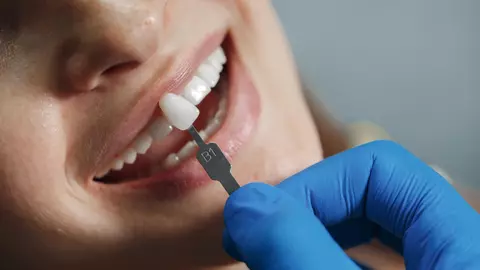 Tot ce trebuie să știi despre igiena implanturilor dentare și a fațetelor