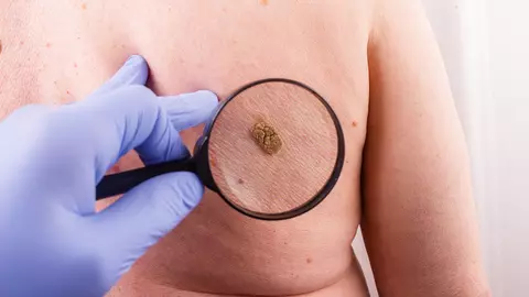O suceveancă de 36 de ani, însărcinată în luna a treia, a murit la spital. Femeia nu știa că avea cancer cu metastaze, ca urmare a ruperii unei alunițe