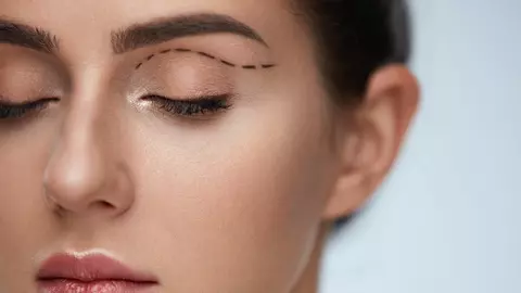 Blefaroplastia: o soluție subtilă pentru un chip întinerit