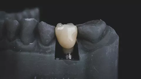 Implanturi dentare: Când sunt recomandate și cum funcționează