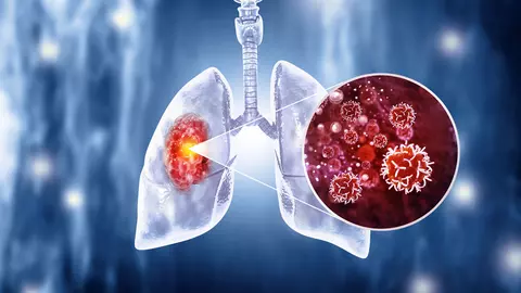 Prima persoană vaccinată împotriva cancerului pulmonar: un bărbat de 67 de ani din Marea Britanie