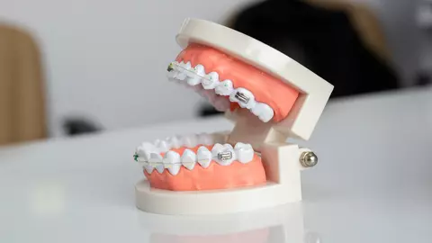 Mituri și adevăruri despre aparatele dentare