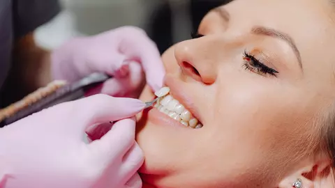 Fațete dentare la Delta Clinic Dent: Soluția pentru un zâmbet natural
