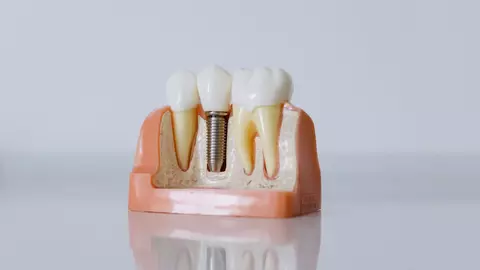 Ce este un implant dentar și cui se adresează