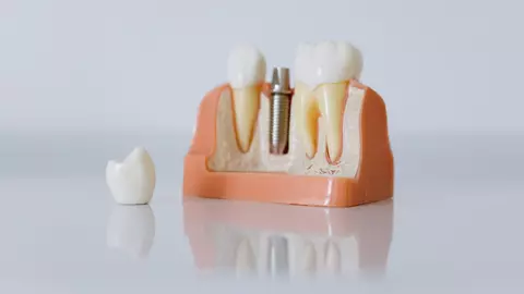 Top 5 avantaje ale implanturilor dentare