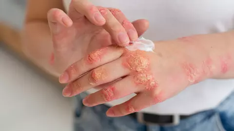 Mi-am ars pielea! Ce fac acum? – ghidul tău de după panica inițială