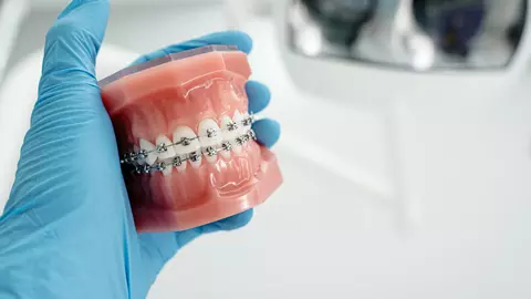 Top 3 beneficii ale tratamentului cu aparat dentar