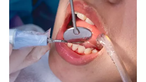 Sănătatea gingiilor începe cu igiena profesională: de ce este important detartrajul regulat?