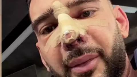 Dorian Popa, prima apariție fără bandaj după intervenția chirurgicală la nivelul nasului: „Un pic umflat”