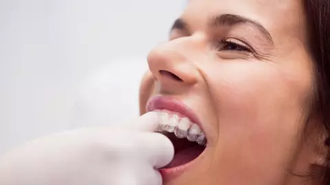 Ce trebuie să iei în considerare dacă alegi un aparat dentar Spark