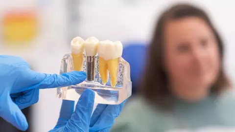 Implanturile dentare: mit și adevăr