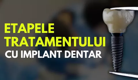 De la consultație la zâmbetul complet: Etapele tratamentului cu implant dentar
