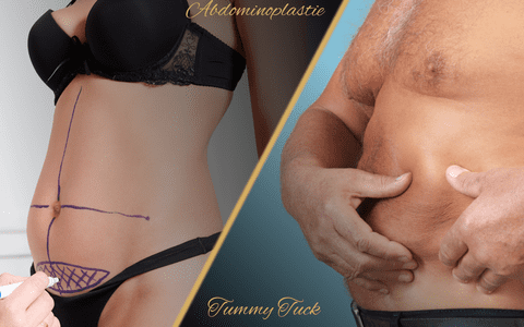 De ce abdominoplastia nu te scapă de burtă