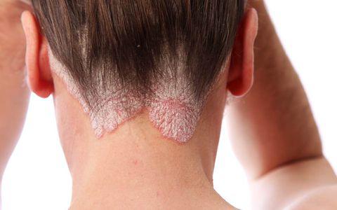 P Este Psoriazisul Contagios Tratamente Moderne Pentru O Boală Incă Neințeleasă Lifestyle Viva Ro Este Psoriazisul Contagios Tratamente Moderne Pentru O Boală Incă Neințeleasă