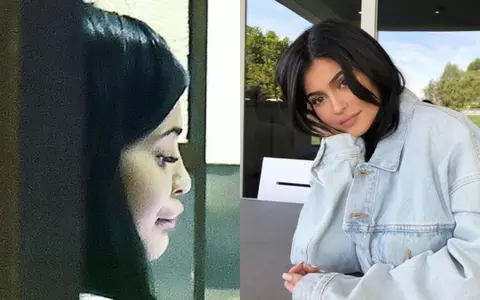 Kylie Jenner a exagerat cu mărirea buzelor. Rezultatul este dezastruos