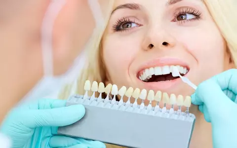(P) Fațetele dentare – un mod simplu de a obține un zâmbet perfect