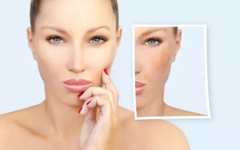 2 remedii naturale pe bază de citrice împotriva petelor pigmentare