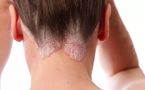 (P) Este psoriazisul contagios? Tratamente moderne pentru o boală încă neînțeleasă