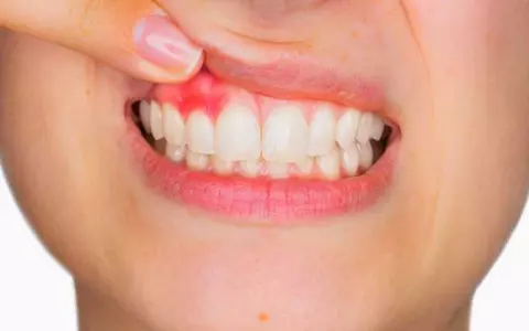 Ce este GINGIVITA şi cât de periculoasă este? Legătura dintre placa bacteriană şi pierderea dinţilor