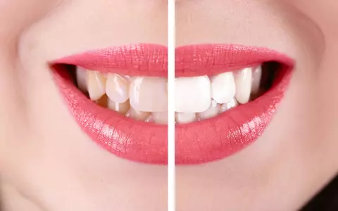 (P) Albirea dentară îți garantează un zâmbet perfect